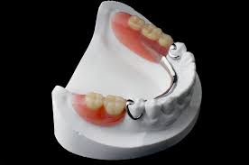 Cast Partial Dentures