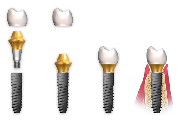 Dental Implant Prosthesis