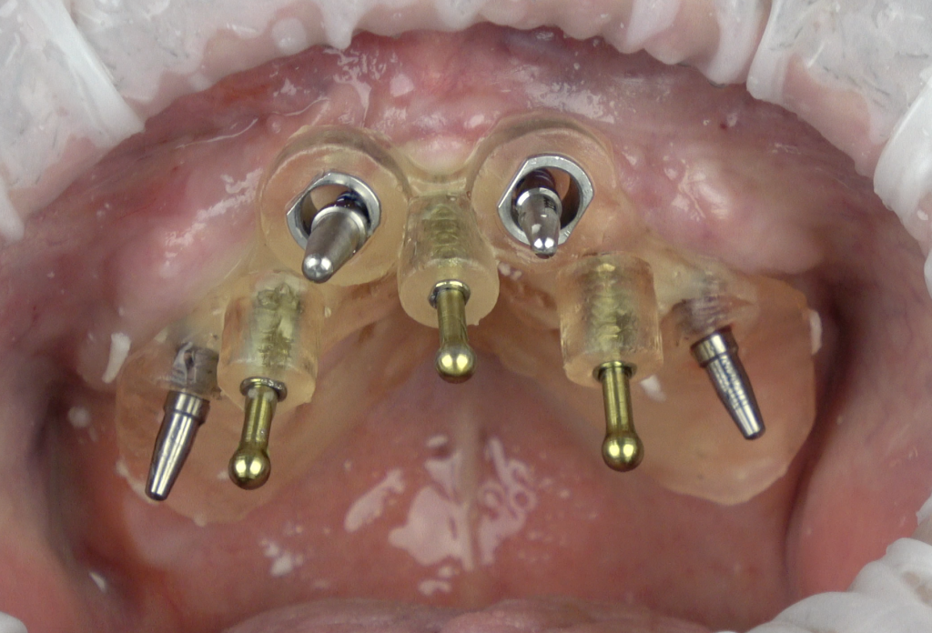 Implant Planning and Surgical Guides